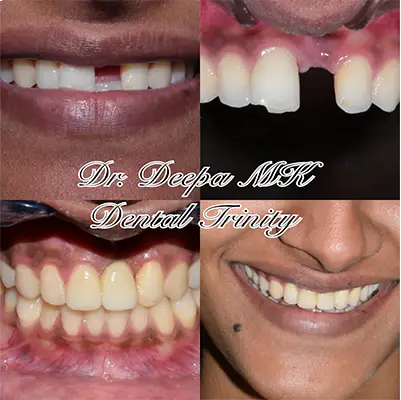 Dental Implants