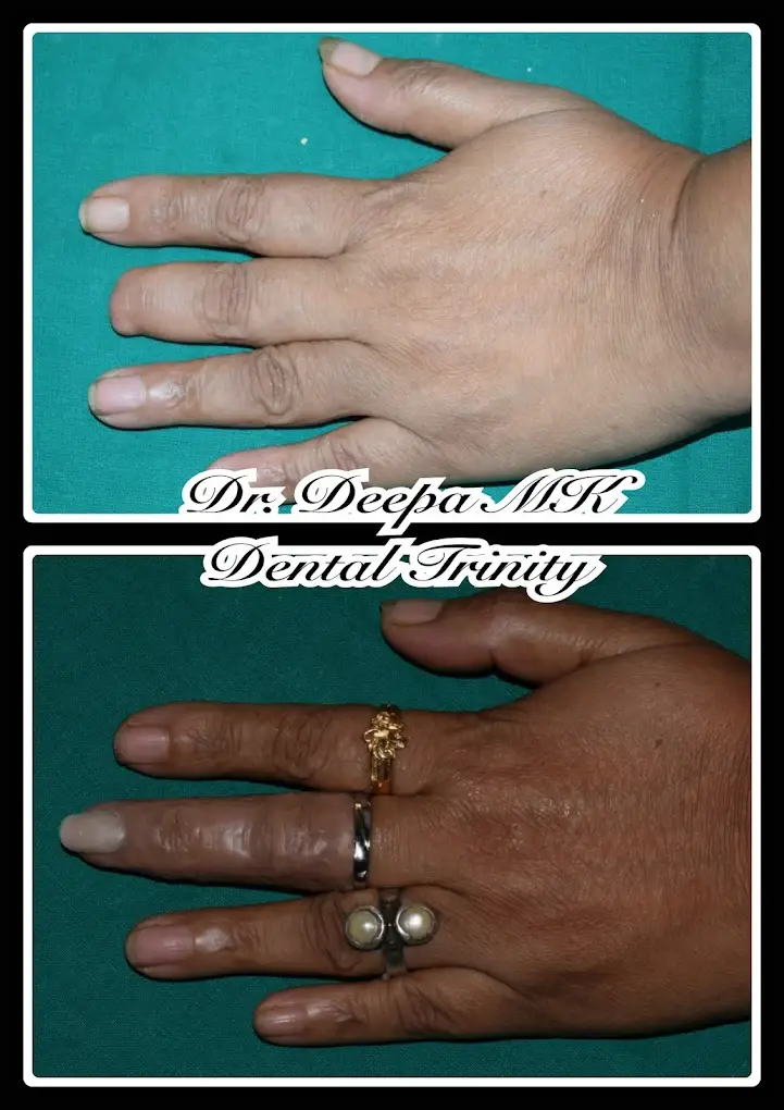 Prosthetic Rehabilitation